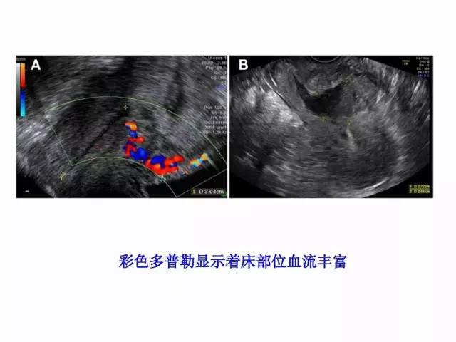 子宮瘢痕懷孕及剖腹產憩室，診斷、處理及預防 親子 第18張