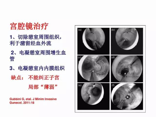 子宮瘢痕懷孕及剖腹產憩室，診斷、處理及預防 親子 第64張