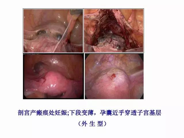 子宮瘢痕懷孕及剖腹產憩室，診斷、處理及預防 親子 第17張