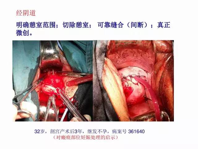 子宮瘢痕懷孕及剖腹產憩室，診斷、處理及預防 親子 第66張