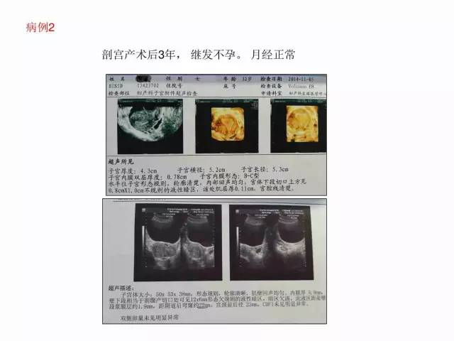 子宮瘢痕懷孕及剖腹產憩室，診斷、處理及預防 親子 第62張