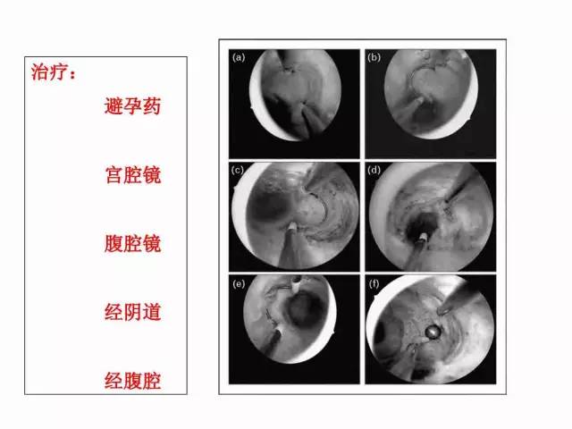 子宮瘢痕懷孕及剖腹產憩室，診斷、處理及預防 親子 第63張