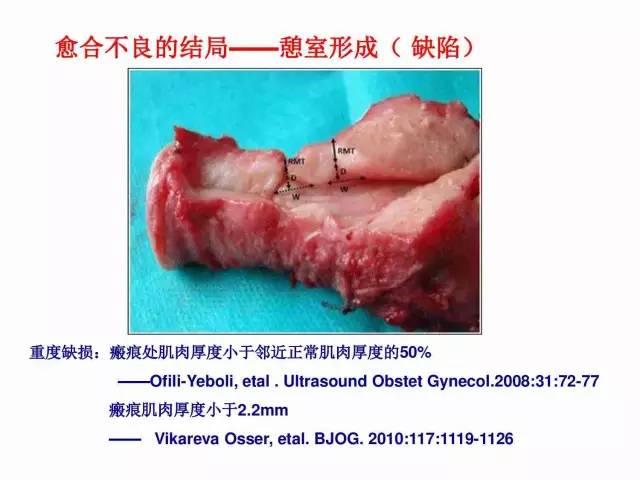 子宮瘢痕懷孕及剖腹產憩室，診斷、處理及預防 親子 第46張