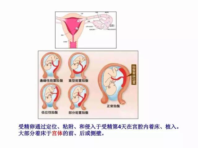 子宮瘢痕懷孕及剖腹產憩室，診斷、處理及預防 親子 第14張