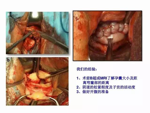 子宮瘢痕懷孕及剖腹產憩室，診斷、處理及預防 親子 第31張