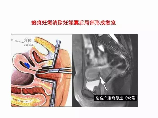 子宮瘢痕懷孕及剖腹產憩室，診斷、處理及預防 親子 第44張