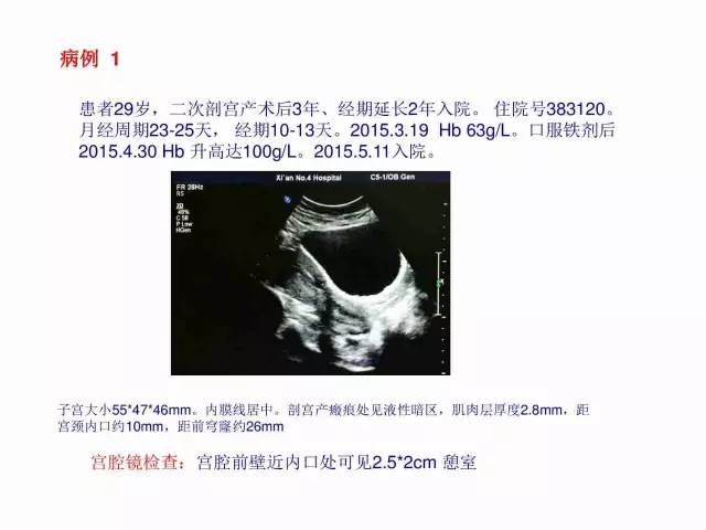 子宮瘢痕懷孕及剖腹產憩室，診斷、處理及預防 親子 第61張