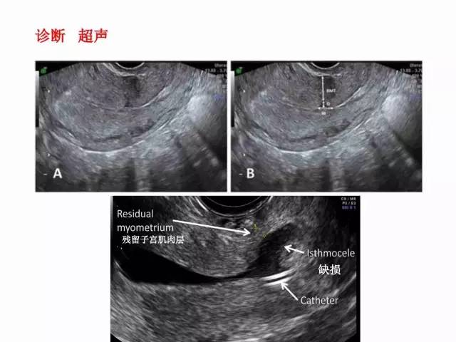 子宮瘢痕懷孕及剖腹產憩室，診斷、處理及預防 親子 第49張