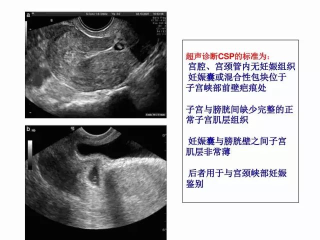 子宮瘢痕懷孕及剖腹產憩室，診斷、處理及預防 親子 第16張