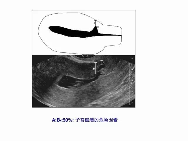 子宮瘢痕懷孕及剖腹產憩室，診斷、處理及預防 親子 第58張