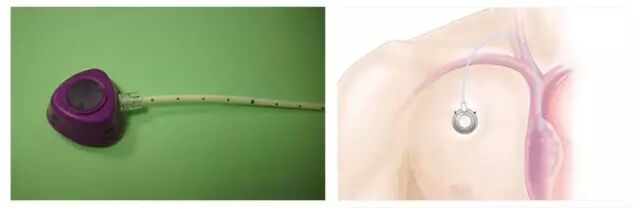 动脉留置针怎么输液留置针、CVC、PICC、输液港有什么区别？4 种输液法大对比_https://www.jmylbn.com_新闻资讯_第5张