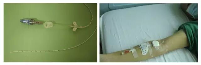 动脉留置针怎么输液留置针、CVC、PICC、输液港有什么区别？4 种输液法大对比_https://www.jmylbn.com_新闻资讯_第4张