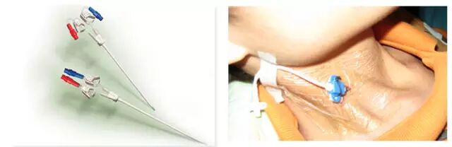 动脉留置针怎么输液留置针、CVC、PICC、输液港有什么区别？4 种输液法大对比_https://www.jmylbn.com_新闻资讯_第3张