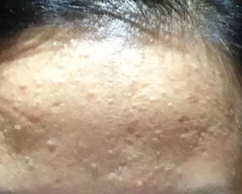 闭合的小粉刺，不能挤的小肉球，你怎么做的？