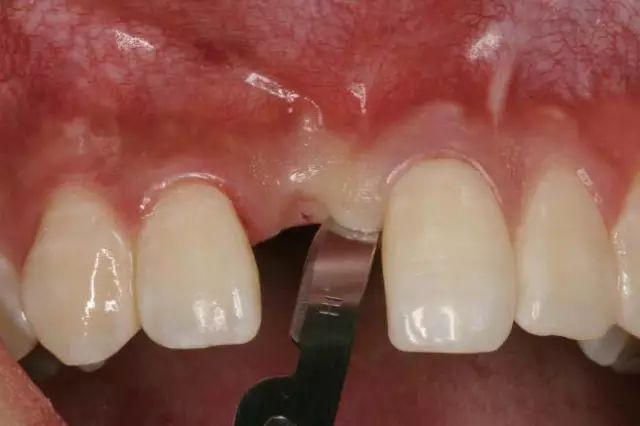 翻瓣手术如何做，看完这篇手术思路更清晰！