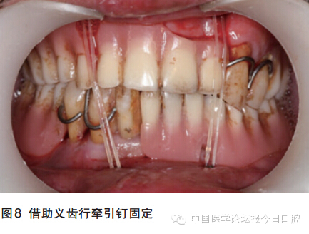 牙周夹板固定要多少钱图片