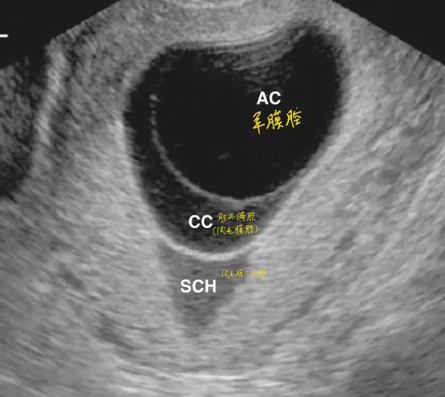 絨毛膜下血腫 Haoyisheng 微文庫