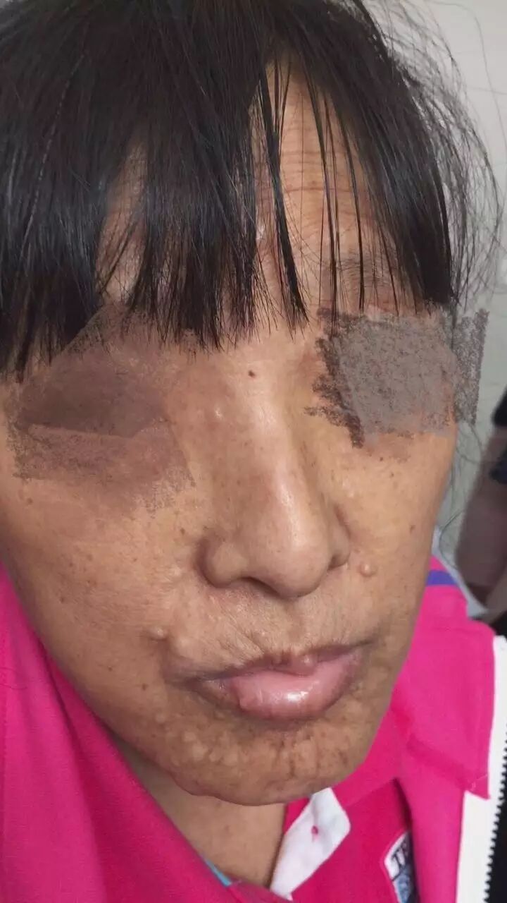 病例讨论室第一期:滑膜肉瘤案