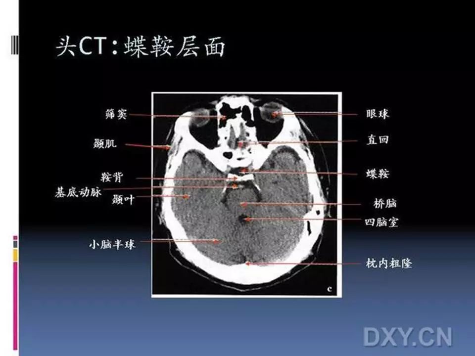 10张图搞定正常头颅ct断层解剖