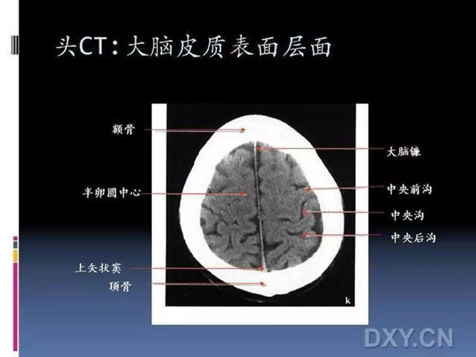 10张图搞定正常头颅ct断层解剖