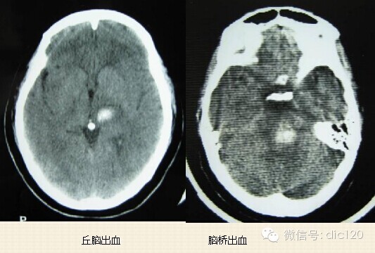 图文解析高血压性脑出血
