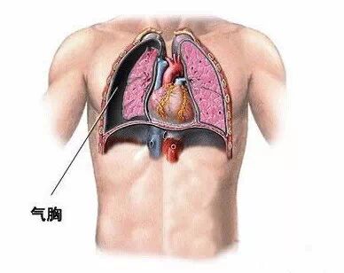 麦霸小心k歌飙高音可能爆肺严重致命
