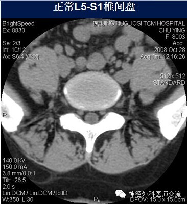 腰椎间盘膨出突出椎管狭窄ct诊断