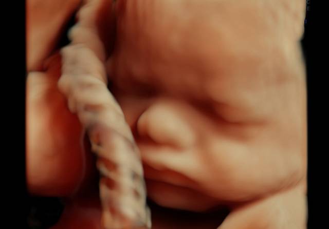 VOlusonE什么彩超机「升级」“金标版”GE Voluson E10四维彩超——从高清到高精，每一帧都是爱与期待的模样_https://www.jmylbn.com_新闻资讯_第6张