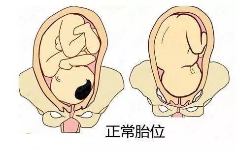 胎儿臀位女儿图片