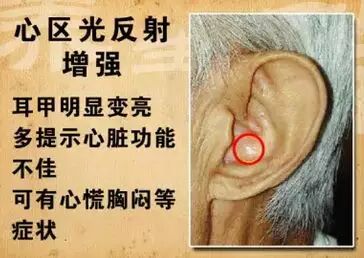 另外,我们可以看耳垂,从耳朵上诊断冠心病主要是看"冠状沟".
