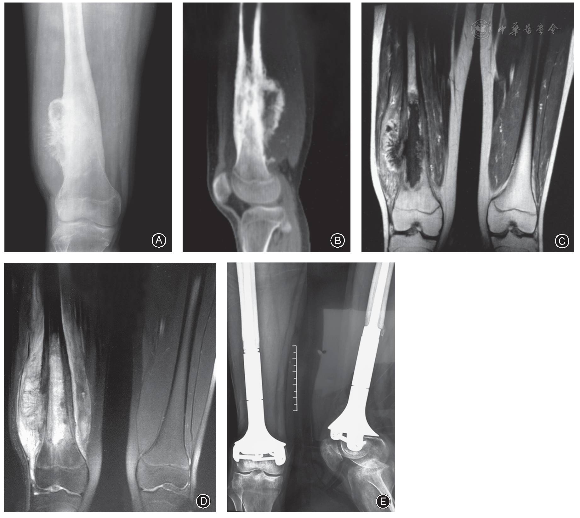 【精彩文章推荐】儿童股骨远端骨肉瘤保留骨骺的定制肿瘤型假体重建术