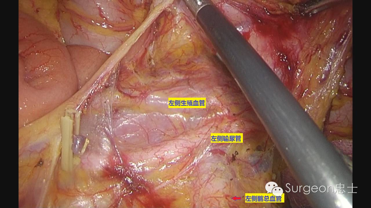 戏说腹腔镜直肠手术洞穴探秘
