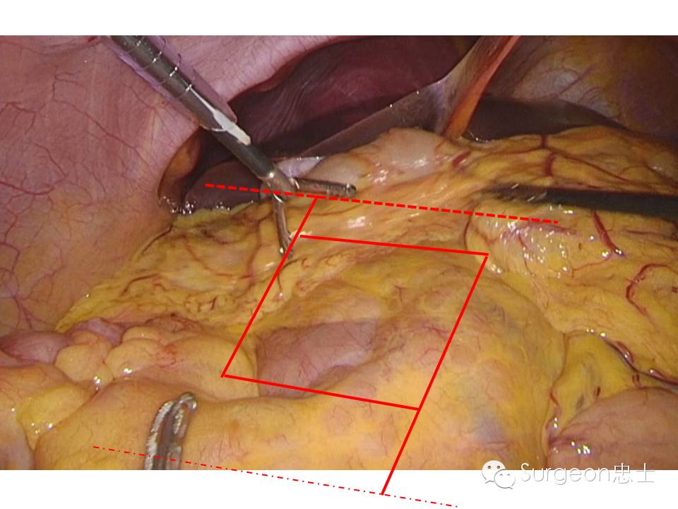 悟道:腹腔镜右半结肠切除术外侧入路"互"字形游离技术 - 好大夫在线
