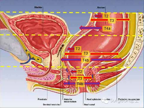 直肠周围系膜空间明显变小延伸为内外括约肌间隙.