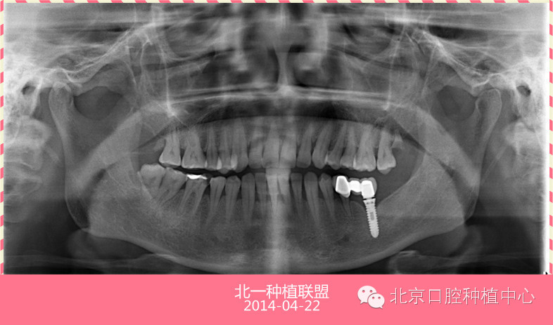 种植体和天然牙联合支持的固定修复靠谱吗？-北京北一的博客-KQ88口腔博客