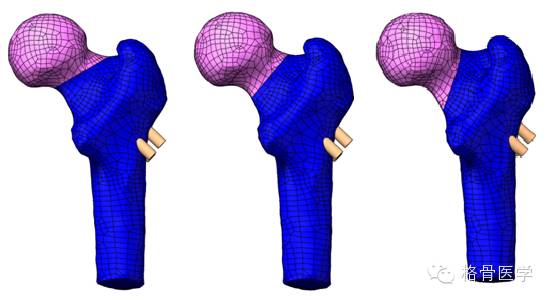"倒品字"与"品字"空心钉不同pauwels分型骨折的生物力学性能研讨