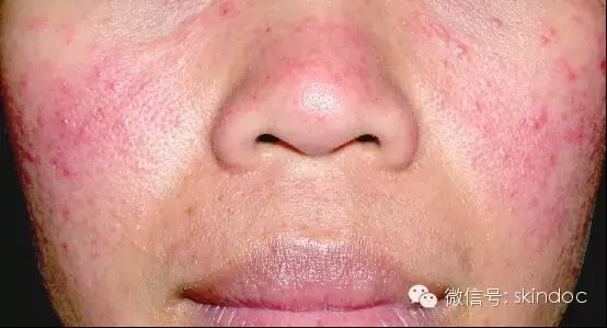 临床释疑 酒渣鼻与蠕形螨 蠕形螨病 Skin304 微信公众号文章阅读 Wemp
