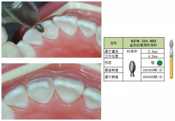 【牙体预备】标准化预备/车针使用技巧 