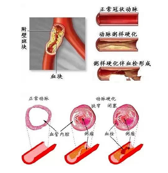 再也不用擔心血管堵塞了,5秒淨化血液