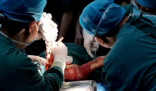 与我院小儿外科,手术麻醉科组成烧伤救治手术团队,患儿在全身麻醉