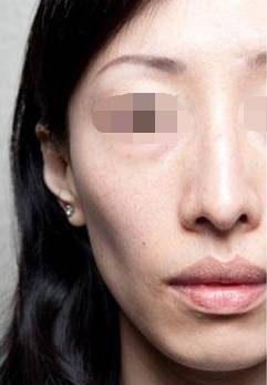 面部凹陷不饱满怎么办