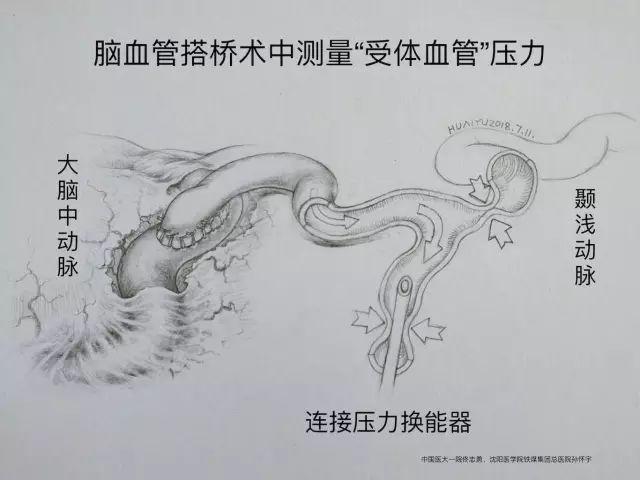 腦血管搭橋術中血管壓力測量