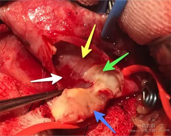 非常菲薄蓝色箭头,壁间血肿,上缘可以看到红色的血栓覆盖了一层内膜