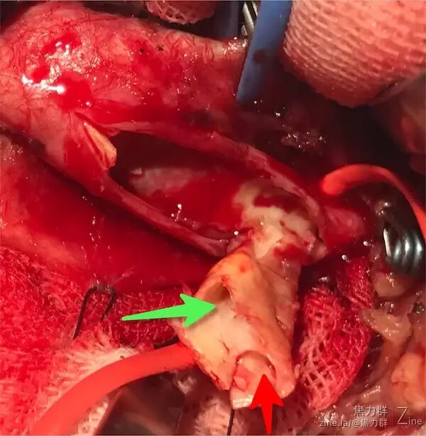 焦力群教授从手术的角度看颈动脉夹层