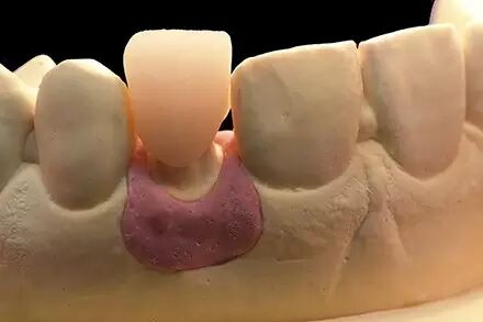 【飞鹰小讲堂】vita三层色玻璃陶瓷制作的前牙全冠