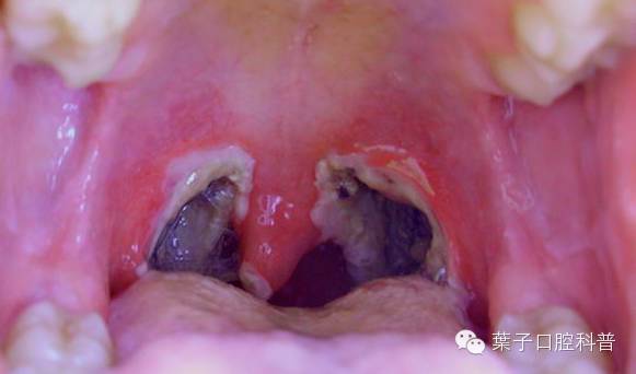 也许摘除扁桃体能治愈!#叶子口腔科普