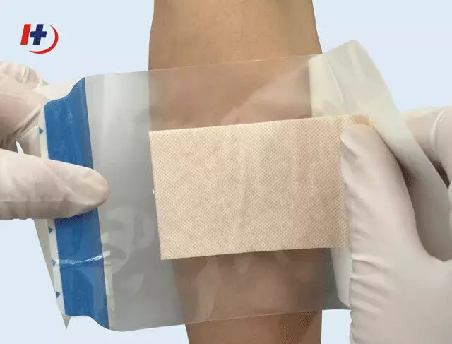 壳聚糖生物敷料治什么【护创大讲堂】护创壳聚糖敷料特点与使用方法（临床应用）_https://www.jmylbn.com_新闻资讯_第7张