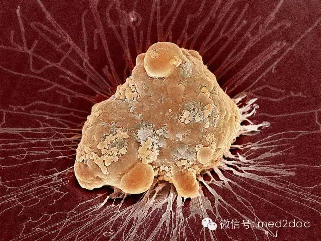 电子显微镜 癌细胞图片