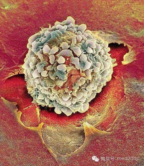 电子显微镜 癌细胞图片