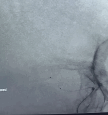 动脉长鞘怎么置入有励可说｜Locaste 088励楷长鞘及Tarvos微导丝在右侧大脑中动脉M2段取栓术中的应用_https://www.jmylbn.com_新闻资讯_第17张